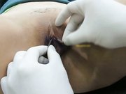 新加坡华裔帅哥整形医学博士内部交流视频外阴唇切除巧变馒头逼